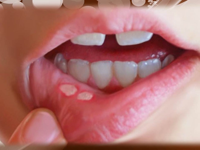 aphthous stomatitis에 대해 알 수있는 눈에 보이는 징후는 무엇입니까? aphthous 유형의 구내염 결정